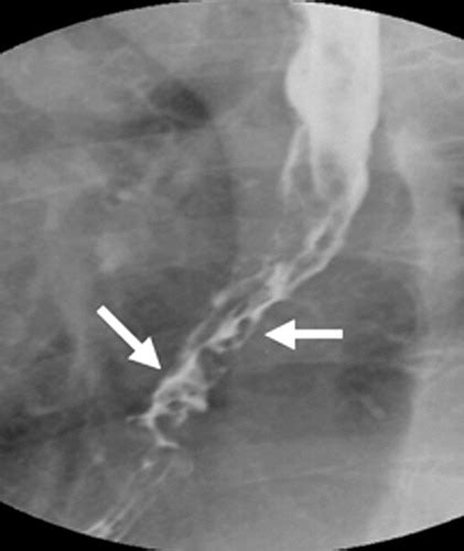 esophageal varices radiology